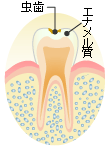 Ｃ１：エネメル質の虫歯
