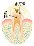 Ｃ２：象牙質の虫歯