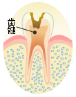Ｃ３：歯髄（歯の神経）の虫歯