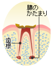 Ｃ４：虫歯の末期