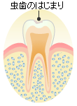 Ｃ０：初期虫歯