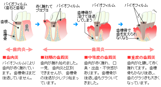 歯周病の進行