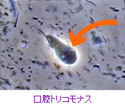 原虫:口腔トリコモナス