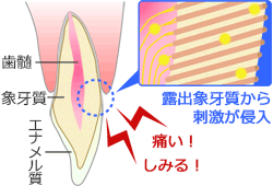 知覚過敏