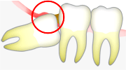 知歯歯周炎（親知らずの炎症）の炎症緩和