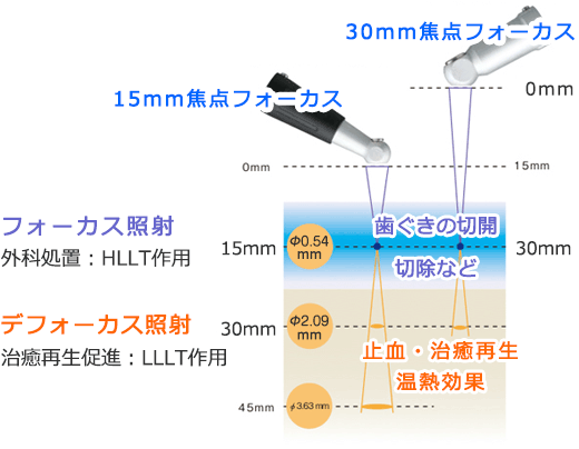 痛くない治療・やさしい治療・歯を守る治療！ 最新鋭レーザー治療器によるＭＩ治療