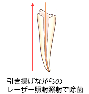 根管治療