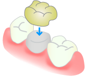 セラミッククラウン