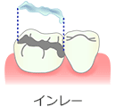 ジルコニアインレー