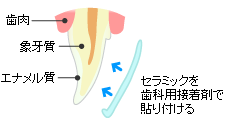 ラミネートベニア