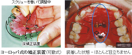ヨーロッパ式の矯正装置（可撤式）