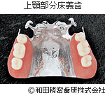 上顎部分床義歯