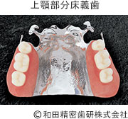 上顎部分床義歯