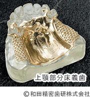 上顎部分床義歯（チタンプレート）