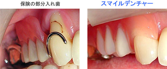 部分入れ歯の比較