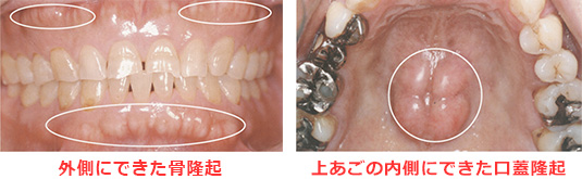 歯ぎしり（ブラキシズム）がおよぼす歯への影響