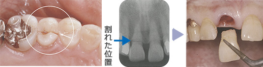 歯ぎしりが原因で割れた歯