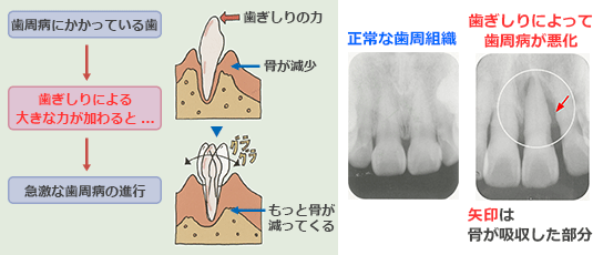 歯周病と歯ぎしりの相乗作用