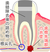 過度な歯ぎしりが及ぼす炎症