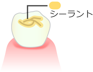 シーラント