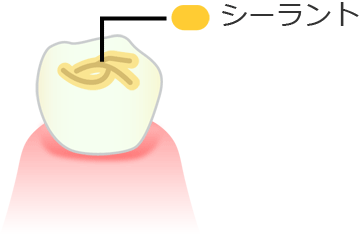 シーラント