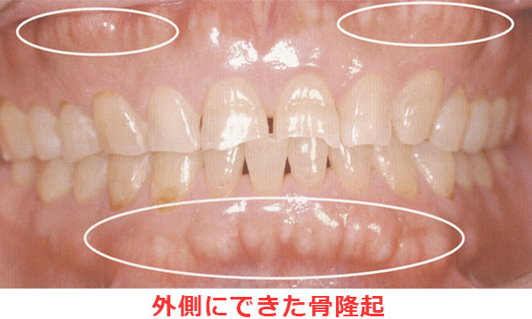 歯ぎしり防止・ナイトガード / 岐阜市の歯医者さん 赤塚歯科医院