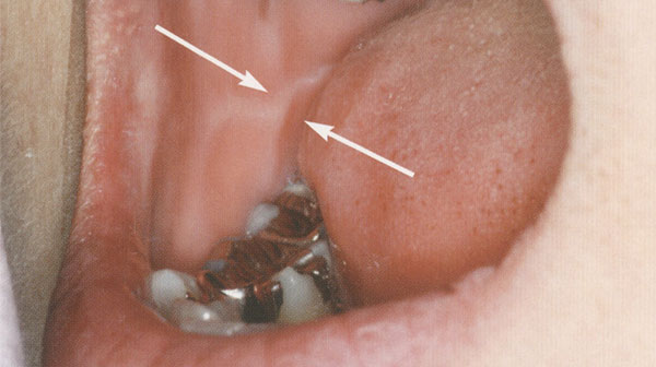 歯ぎしりによる頬・舌粘膜の圧痕