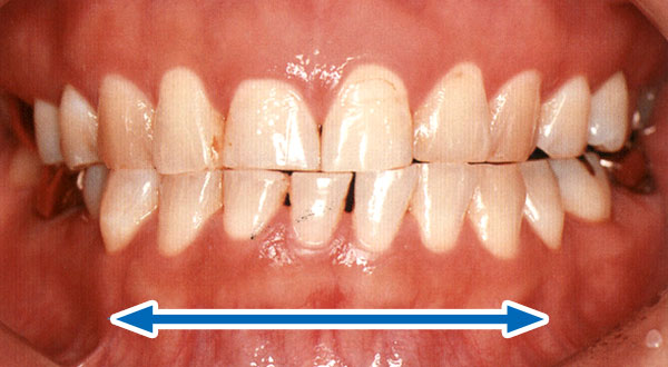 歯ぎしり型（グラインディングタイプ）