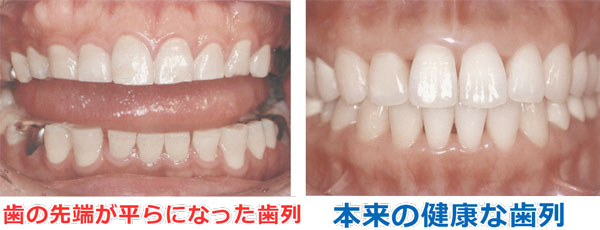 正常な歯並びと歯ぎしりのある歯並びの比較