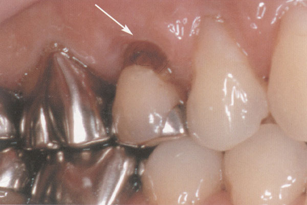 歯の根元のくぼみ（くさび状欠損）