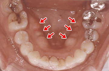 骨隆起によって歯ぐきが膨らみ、触れると硬く骨ばった状態