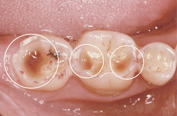 歯ぎしりによって硬い工ナメル質が大きくすり減り、象牙質も見えてしまっています。
