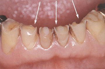 歯ぎしりによって象牙質が露出し、食べ物や冷たい空気でしみる状態